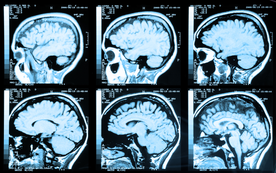 Macomb Law Group handles cases of traumatic brain injury victim from auto accidents. Medical image of an MRI / MRA (Magnetic Resonance Angiogram) of the head showing the brain